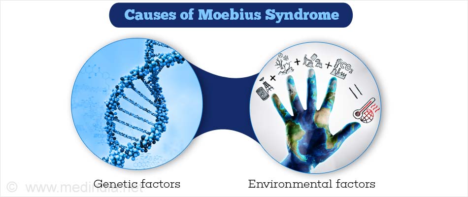Causes of Moebius Syndrome