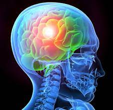 Picture of Xray of TBI in human head.